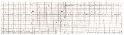 Case Report: Occurrence of Severe Thoracic Aortic Aneurysms (Involving the Ascending, Arch, and Descending Segments) as a Result of Fibulin-4 Deficiency: A Rare Pathology With Successful Management